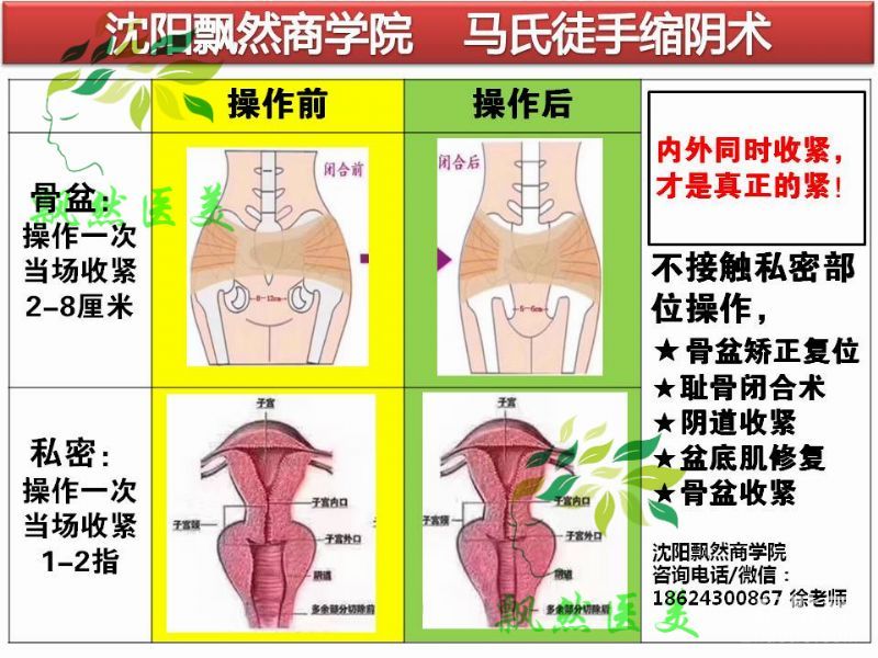 [贵阳]徒手缩阴一指私密定型术私密收紧生殖美疗培训